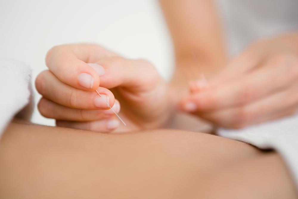 Acupuncture Services in Kendall
