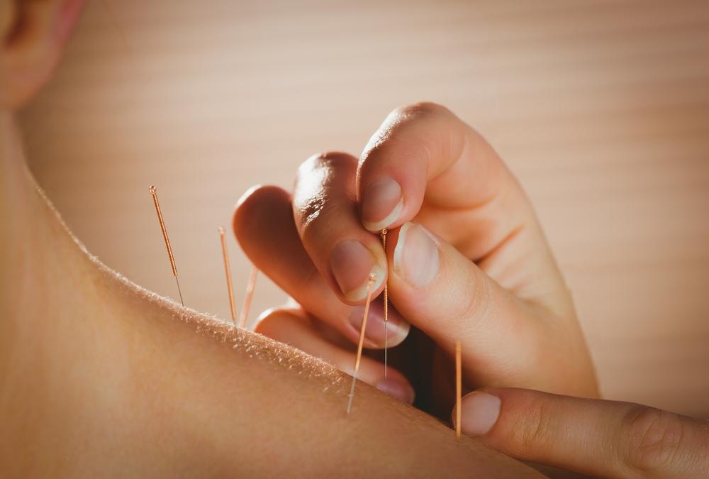 Acupuncture Therapy in Miami